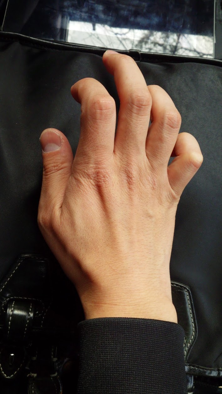 鷲手変形とは 湯元郷治療院日記